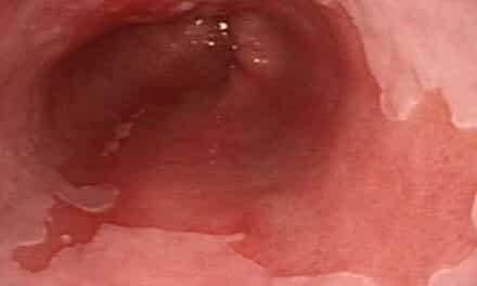 Understanding Barrett’s Oesophagus: A Guide for Paramedics