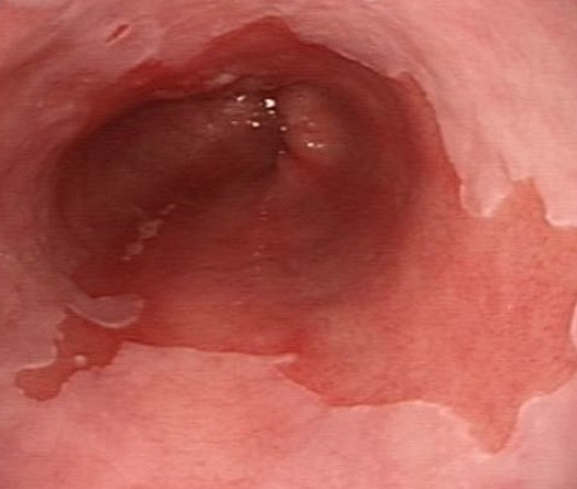 Understanding Barrett’s Oesophagus: A Guide for Paramedics